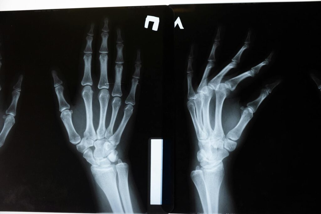 Radiographie de la main et du poignet