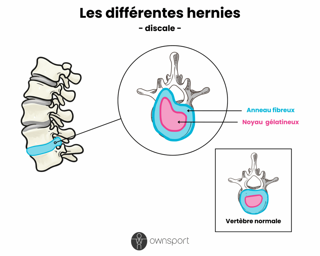 Schéma anatomique de la hernie discale, avec vertèbre anormale et normale.