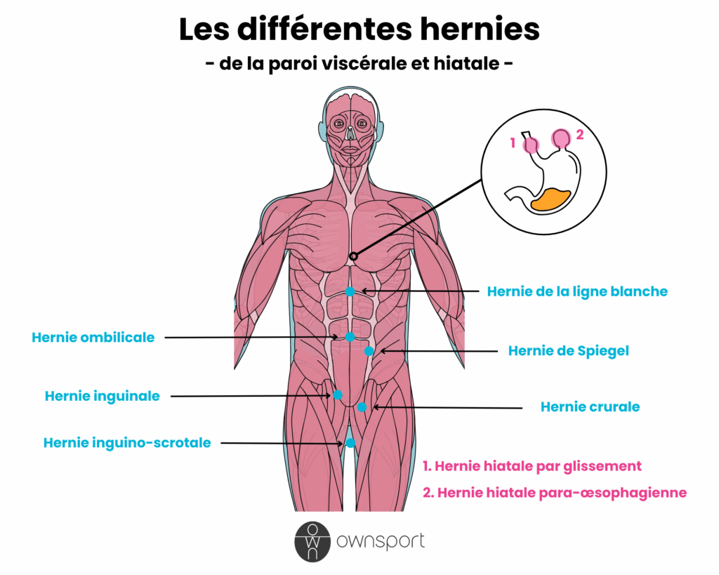 Schéma anatomique du corps humain avec tous les types de hernies viscérales et hiatales.